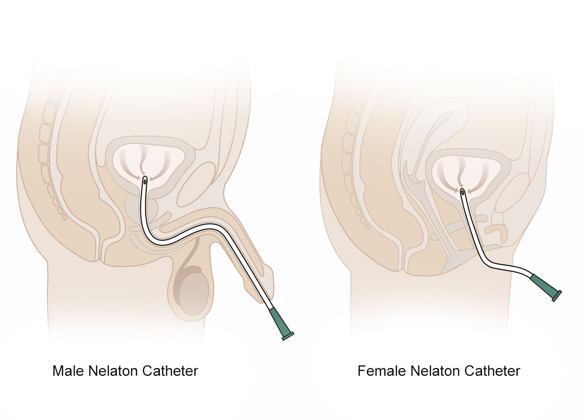 PVC Nelaton Catheters uses scheme