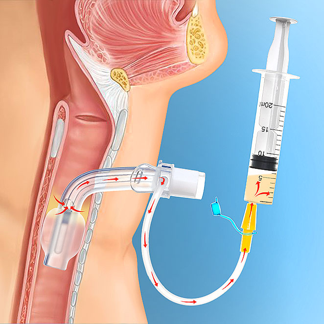 how to use Tracheostomy Tubes Suction-Plus