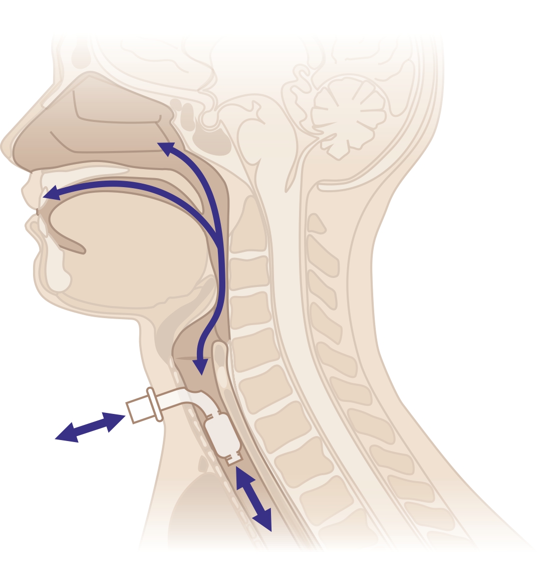 fenestrated tracheostomy tube