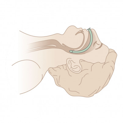 The location of the Nasopharyngeal Airways in the larynx