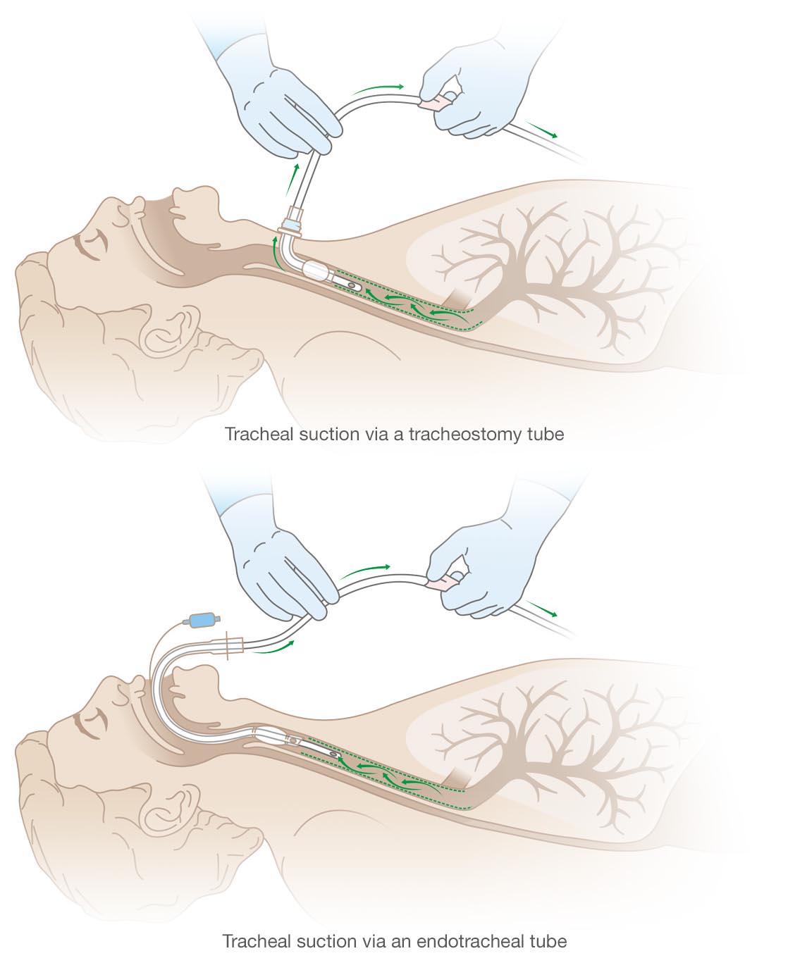 How to suction via a tracheostomy or endotracheal tube