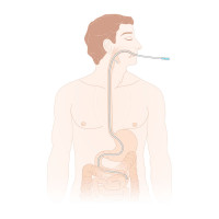 Duodenal Tubes Scheme of use