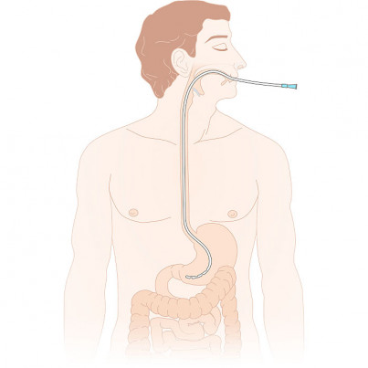 Stomach tube usage scheme