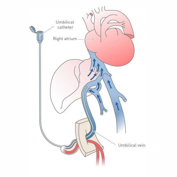 Umbilical Catheters usage scheme