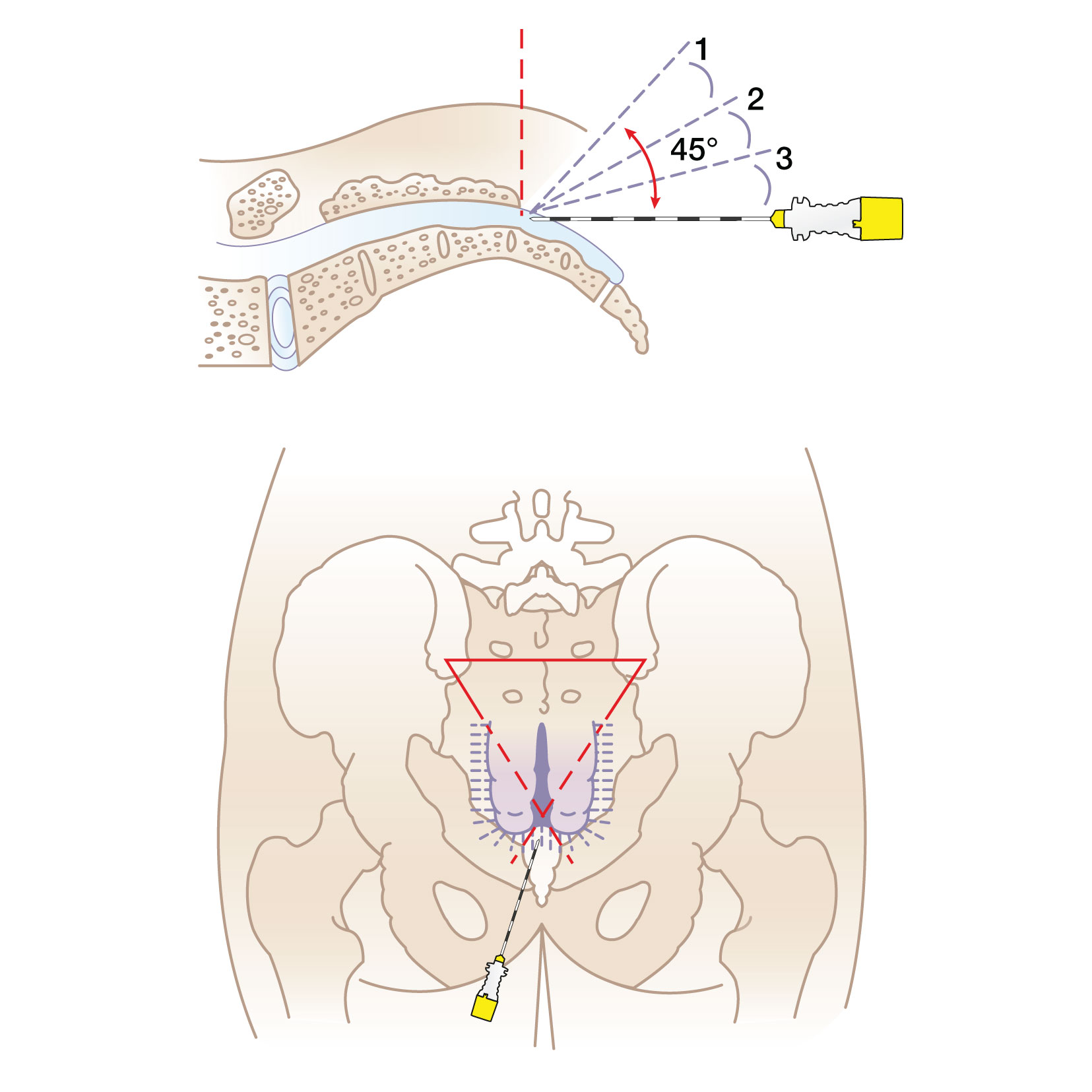 caudal anesthesia technique