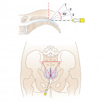 Caudal needles placement