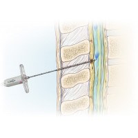 Spinal-epidural needle