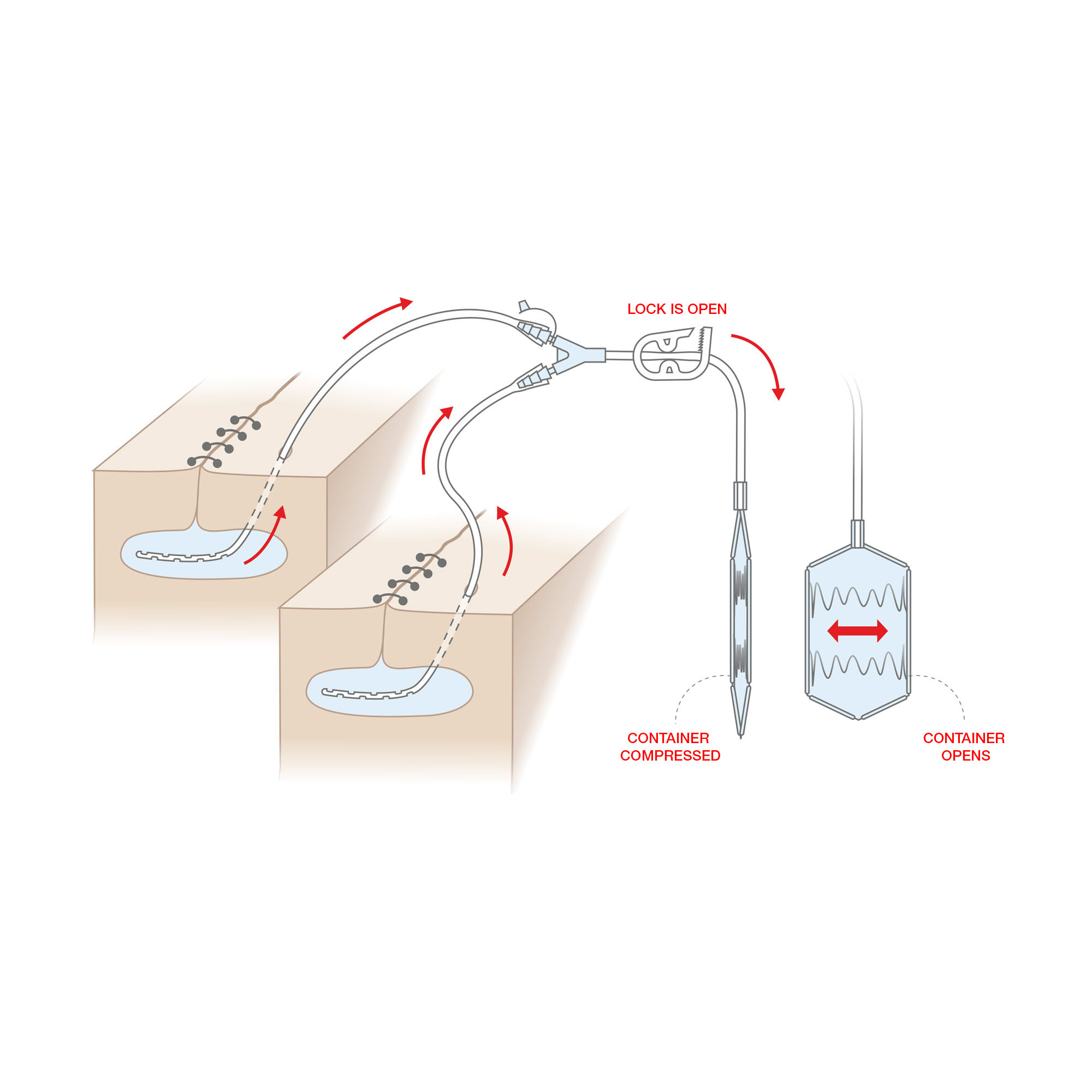 Flat Wound drainage reservoir Spring-Vac