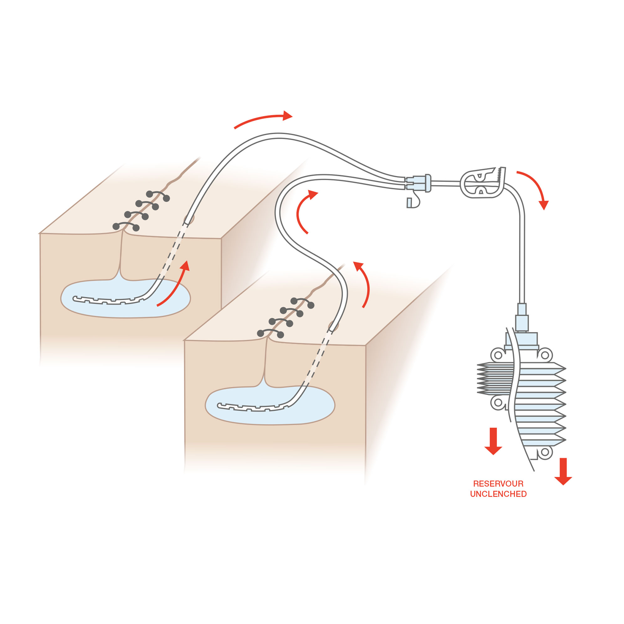 Redon Drainage Set use case