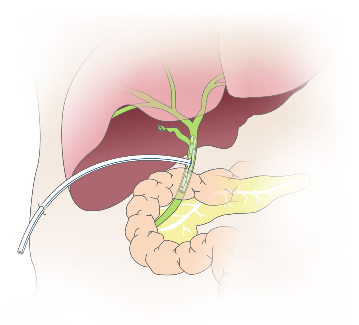 T Tube Drain