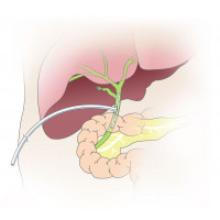 Kehrs T-Tube use set