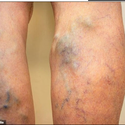 Swelling of the leg, pain or tenderness when standing or walking and hot, red or discoloured skin on the legs are all symptoms (file image of a DVT patient)