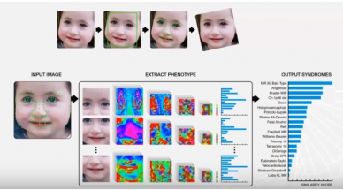 AI Tech Uses Facial Analysis To Detect Rare Genetic Disorders