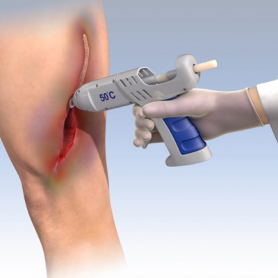 Illustration of the novel medical glue being applied on an incision using a hot-glue gun.