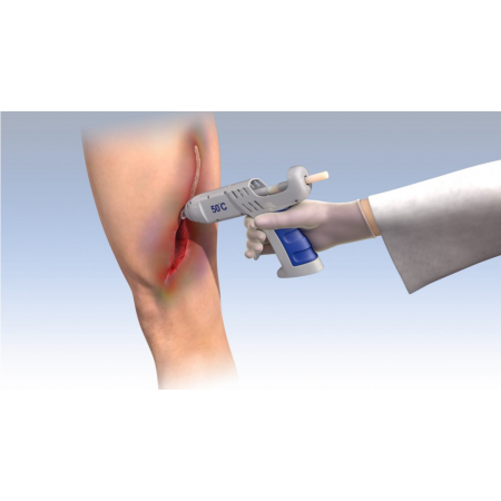 Illustration of the novel medical glue being applied on an incision using a hot-glue gun.