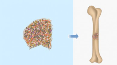 Israeli Patient Is World’s First To Receive Lab-Grown Bone Implant From Own Fat Cells