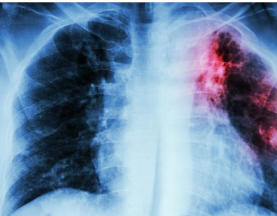 Israel researchers develop algorithm that may help predict onset of tuberculosis