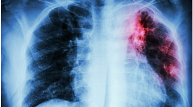 Israel researchers develop algorithm that may help predict onset of tuberculosis