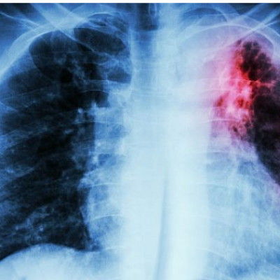 An illustrative image of a chest with pulmonary tuberculosis