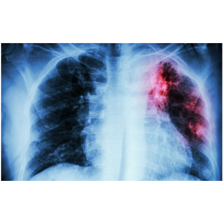 An illustrative image of a chest with pulmonary tuberculosis