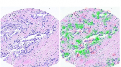 Deep-learning tech reveals personal ID of cancer cells